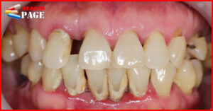 Chronic periodontitis