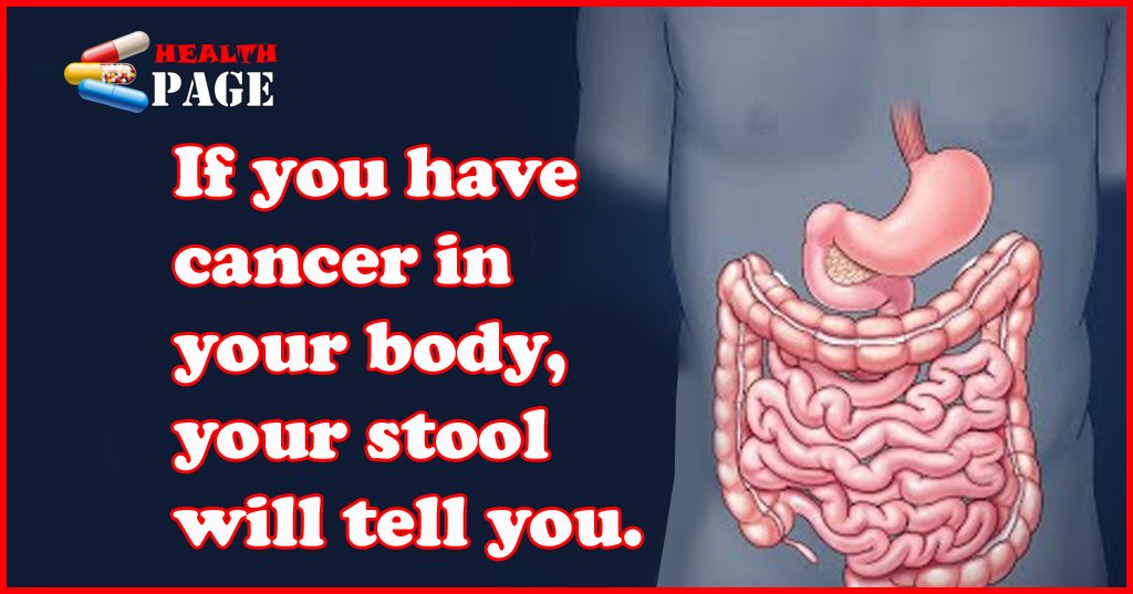 If you have cancer in your body, your stool will tell you.
