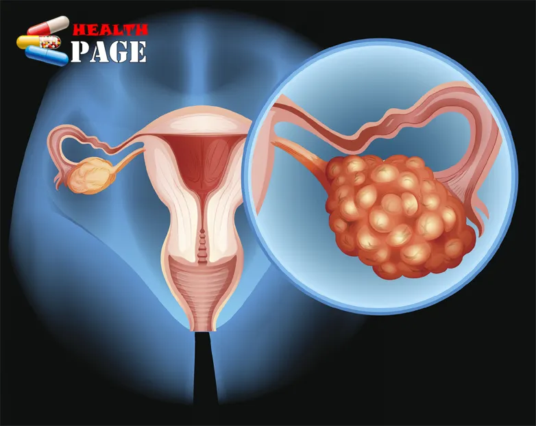ovarian cancer icd 10