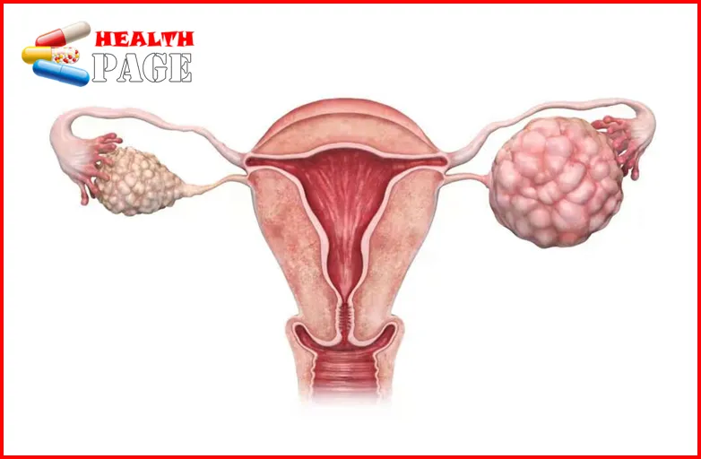 ovarian cancer icd 10