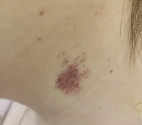 Vascular nevus