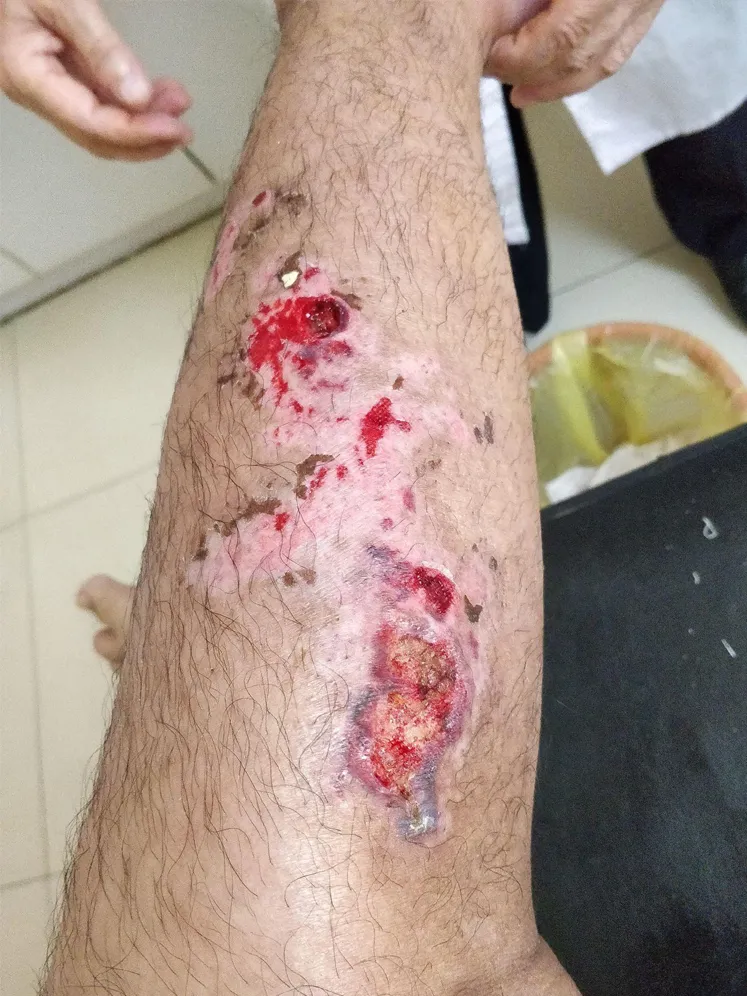 How to clean stitches pus