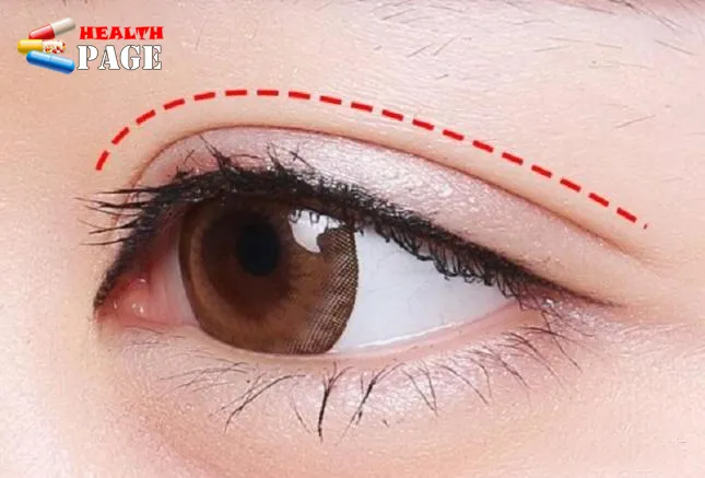 Double eyelid surgery