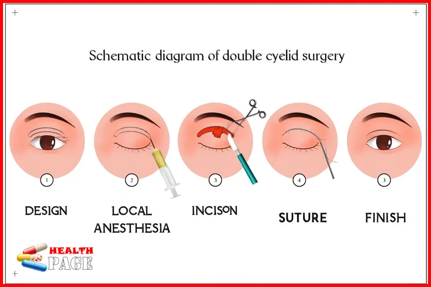 Double eyelid surgery