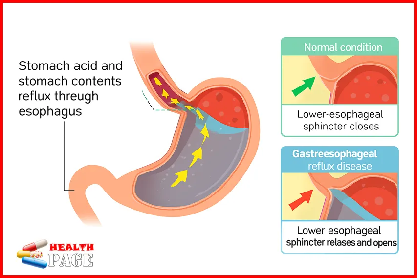 Gastroesophageal Reflux