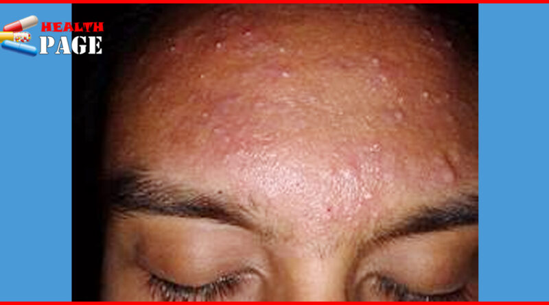 Fungal acne