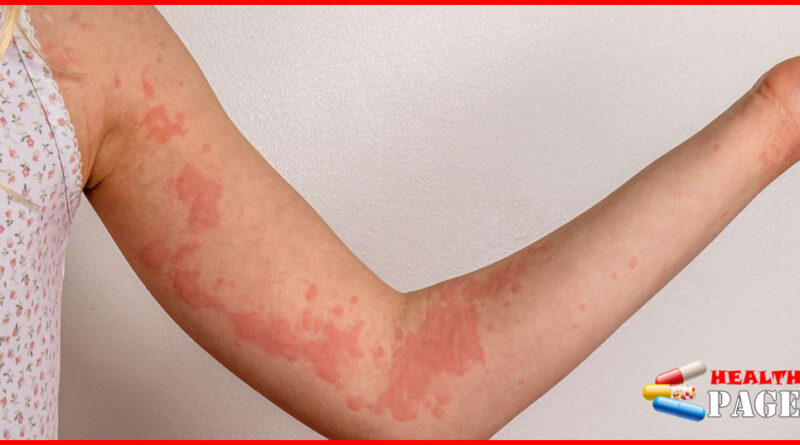 Eczema Rash