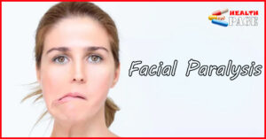 facial paralysis