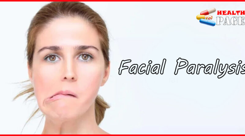 facial paralysis