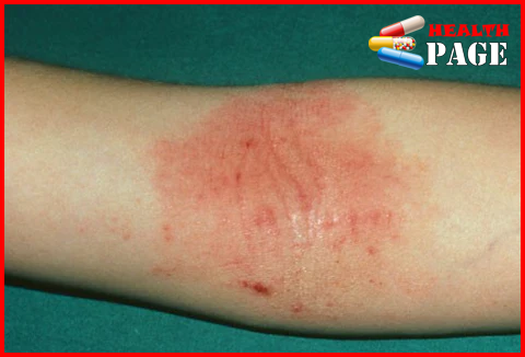 Atopic dermatitis rash on inner elbow