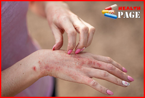 Contact dermatitis rash on hand