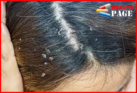 Seborrheic dermatitis flaky scalp