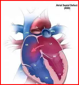 Atrial septal defect