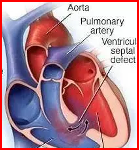 Ventricular septal defect