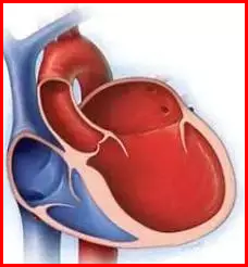 Thinned heart muscle (dilated cardiomyopathy)