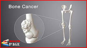 Bone Cancer