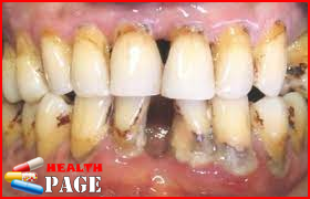 Chronic periodontitis