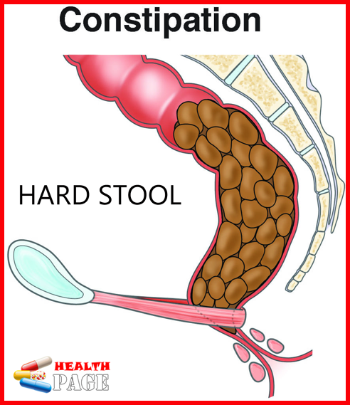 Hard Stool