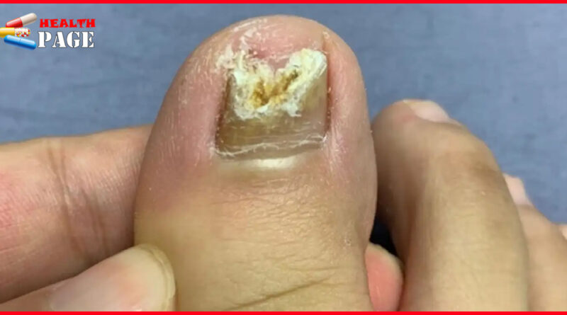 Nail fungus treatment