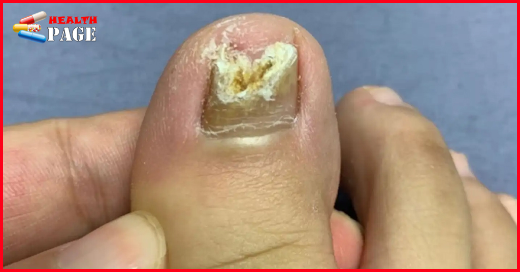 Nail fungus treatment