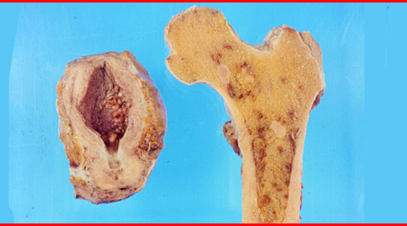 Bone metastasis