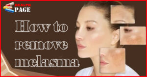 How to remove melasma