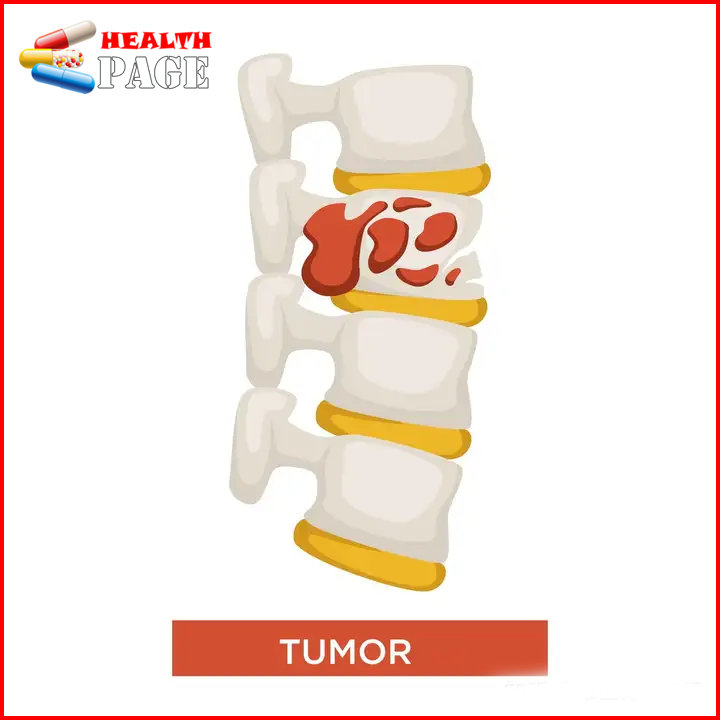 Bone metastasis