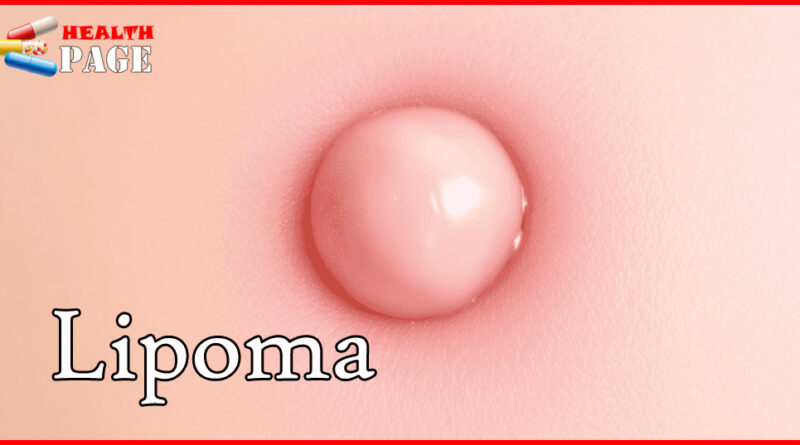 Lipoma ICD 10