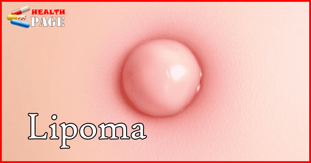 Lipoma ICD 10