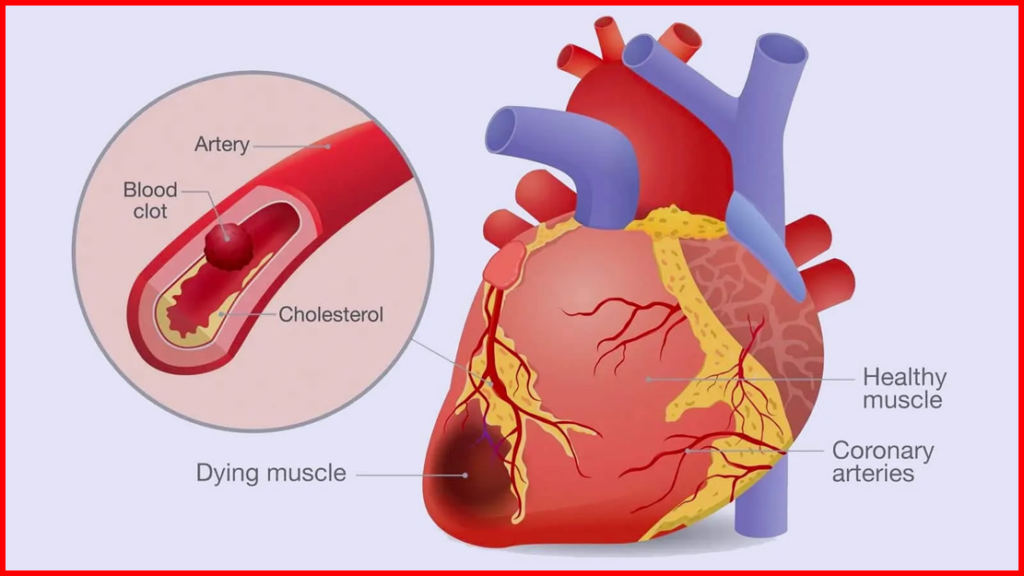 Heart Block