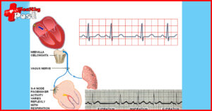 sinus arrhythmia