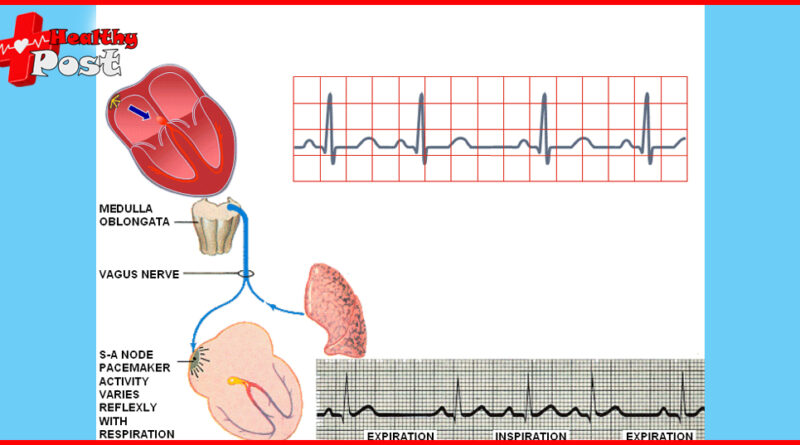 sinus arrhythmia