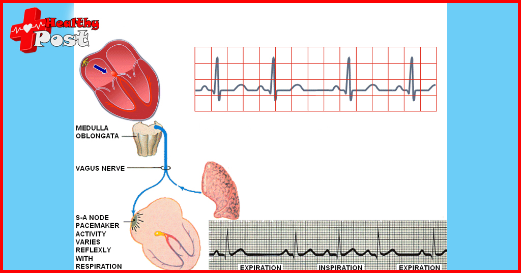 sinus arrhythmia