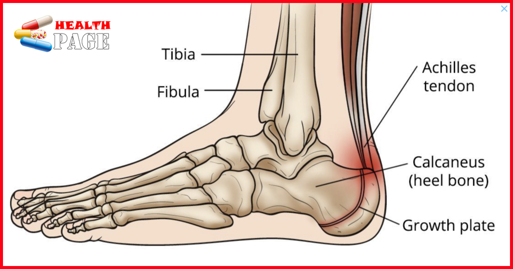 Heel Pain