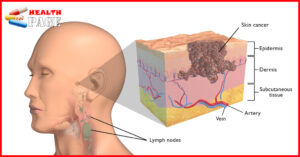 Skin cancer