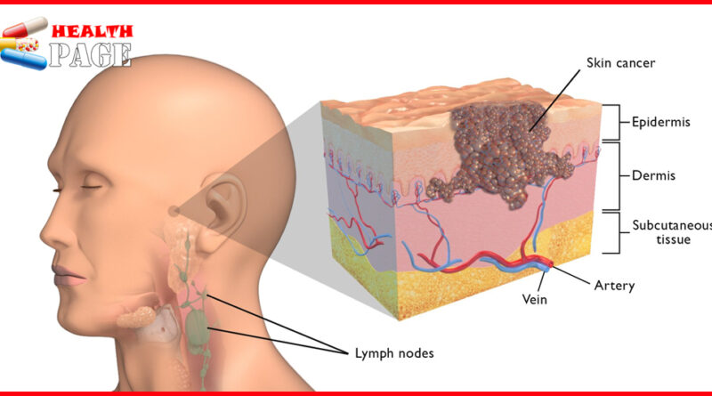 Skin cancer