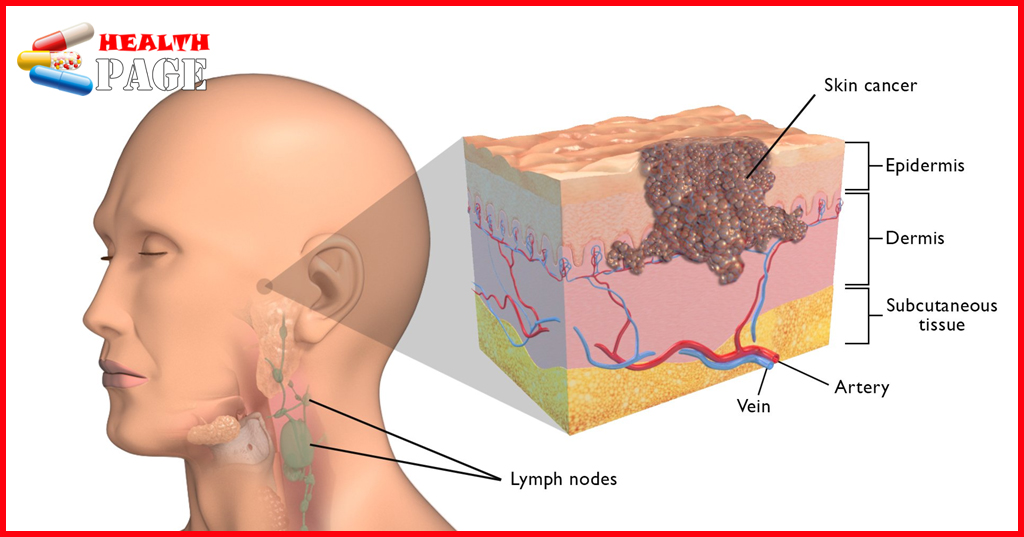 Skin cancer