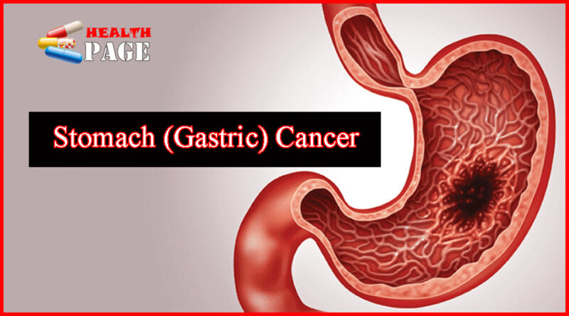 Gastric cancer