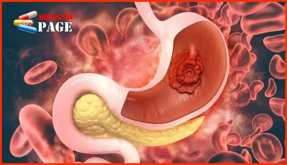 Peptic ulcer