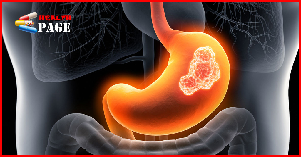 Stomach Cancer