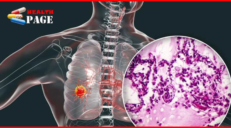 Micropapillary lung adenocarcinoma