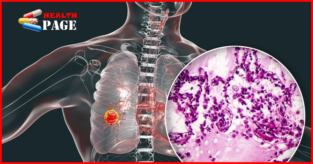 Micropapillary lung adenocarcinoma