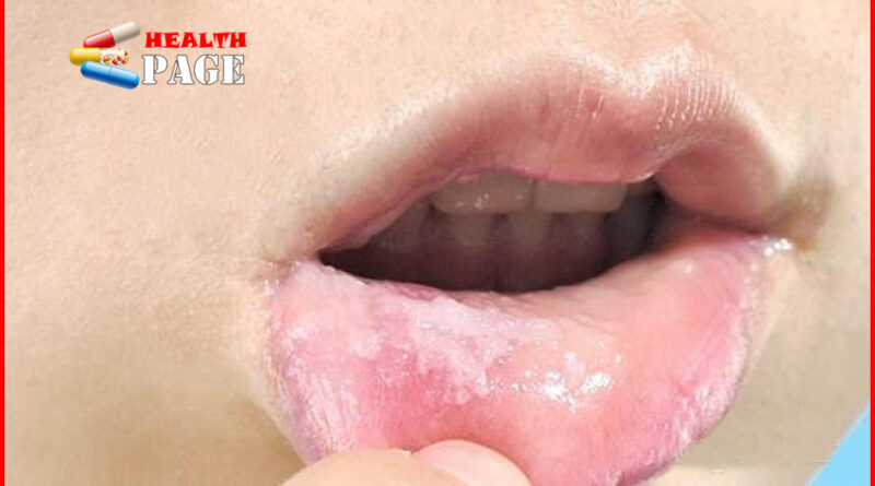 Oral ulcers