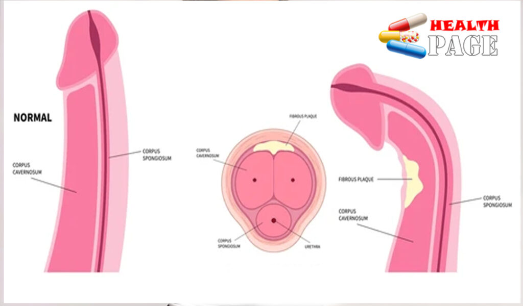 Penile Fracture icd 10