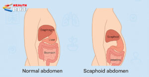 Scaphoid abdomen