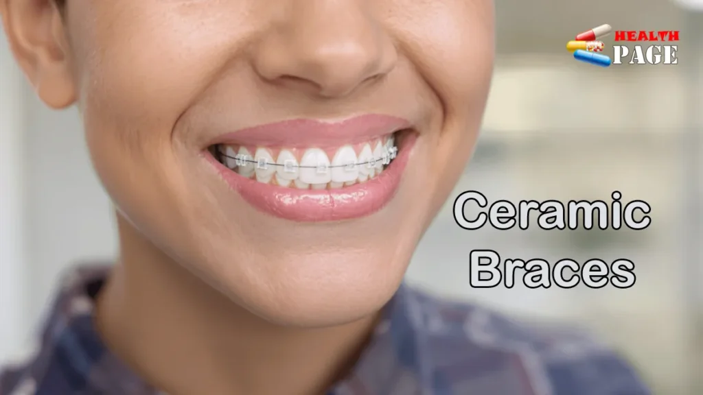 A close-up view of a patient smiling with clear ceramic braces attached to their upper teeth, showcasing their discrete, tooth-colored aesthetic.