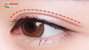 Double eyelid surgery