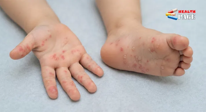 Typical hand, foot, and mouth disease spots and small blisters on a child's palm and sole
