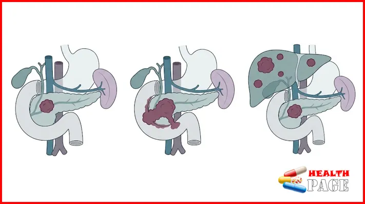 Medical illustration comparing pancreatic cancer confined to the pancreas, spread to nearby tissues, and spread to a distant organ.